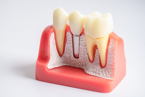 Root Canal Treatment To Remove A Tooth Infection